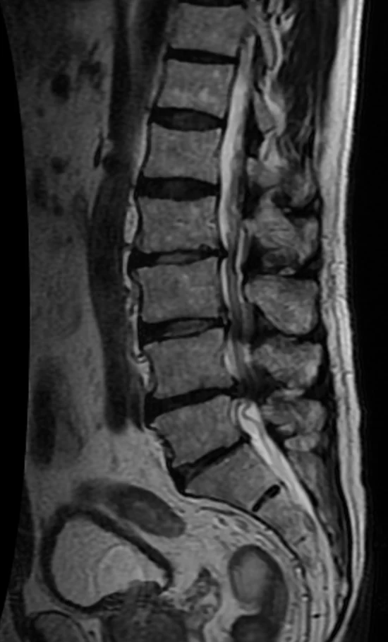 Resonancia de referencia que muestra estenosis lumbar; imagen educativa de Jmarchn