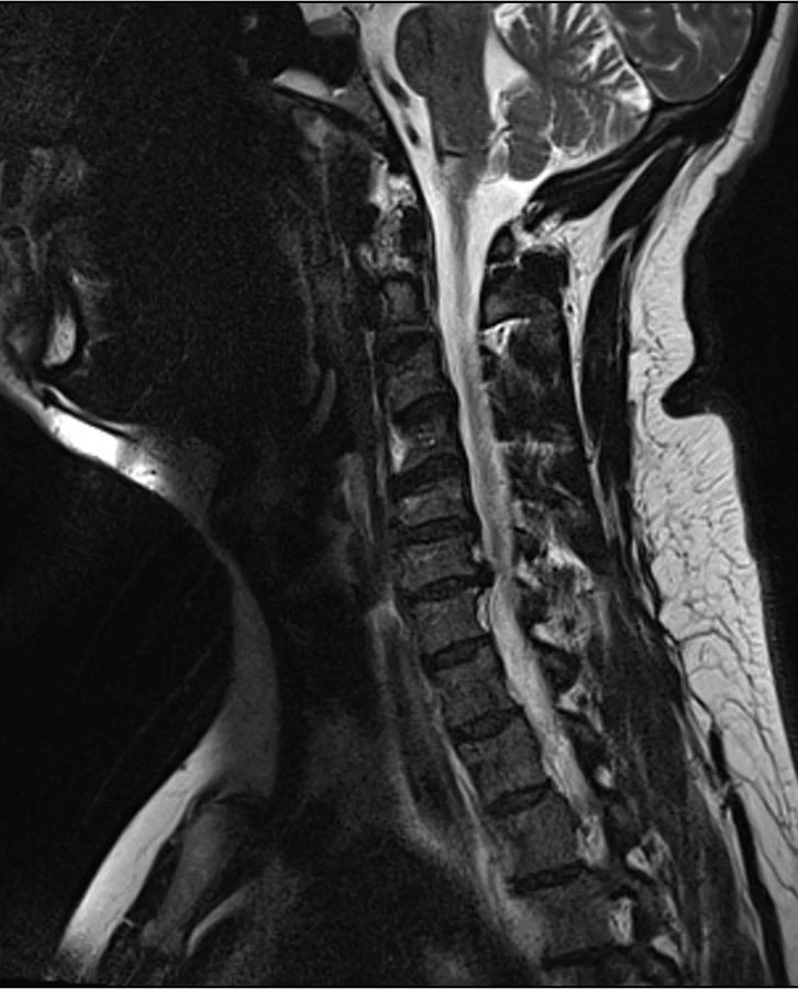 Resonancia cervical de referencia con hernia C6–C7; imagen educativa de Anthonp